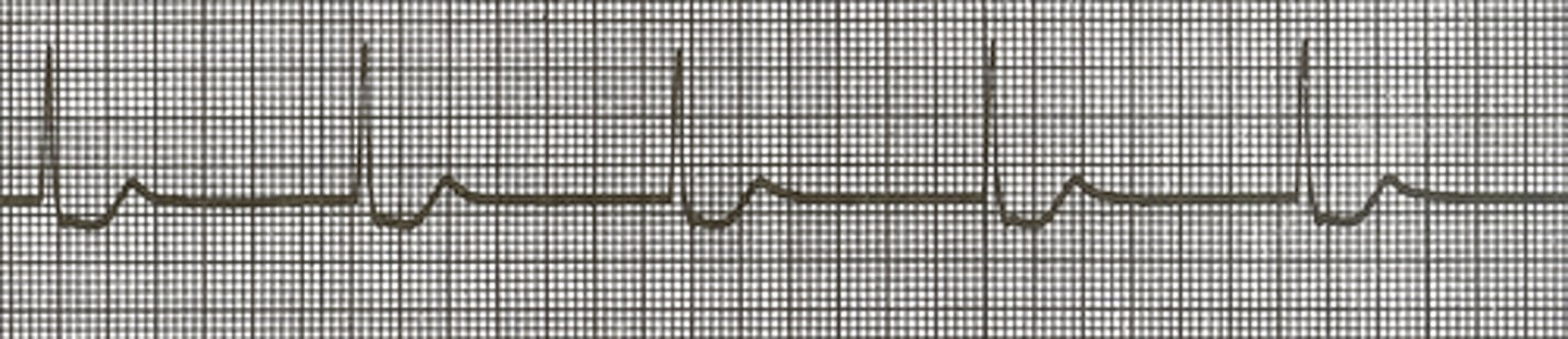 <p>howd yk this was a junctional escape rhythm</p>