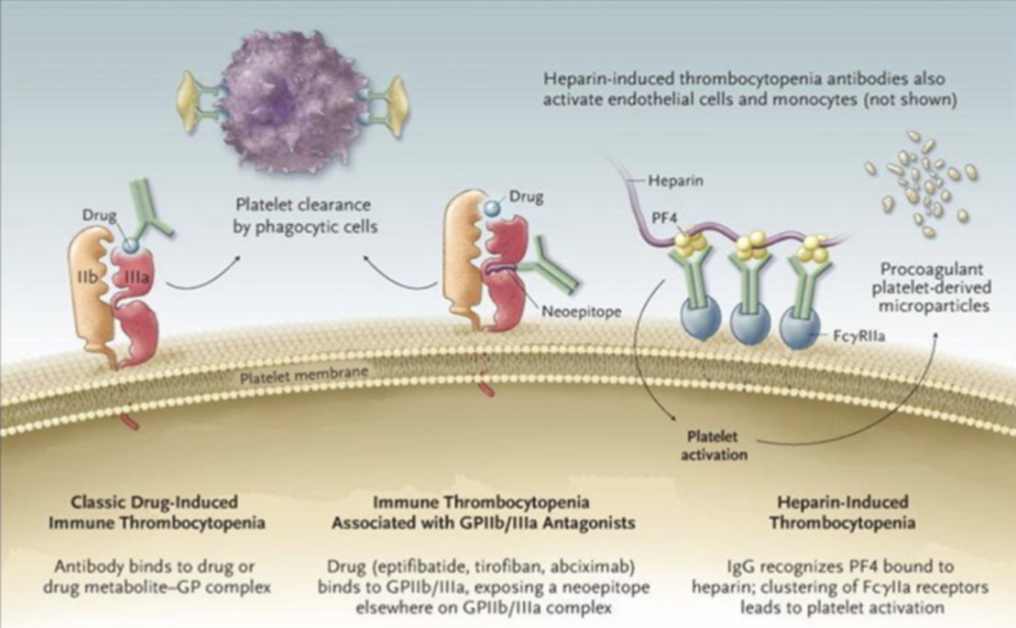<p><span style="background-color: transparent;"><strong><u>Drug-Induced Thrombocytopenia</u></strong></span></p><ul><li><p><span style="background-color: transparent;"><strong>Platelet Clearance (removal)</strong> by _____</span></p></li><li><p><span style="background-color: transparent;"><strong>Heparin Induced thrombocytopenia Abs</strong> also _____ cells + _____</span></p></li><li><p><span style="background-color: transparent;">_____ <strong>platelet-derived microparticles</strong> → _____ Formation</span></p></li><li><p><span style="background-color: transparent;"><strong>Heparin-Induced Thrombocytopenia (HIT)</strong> = _____</span></p></li></ul><p></p>