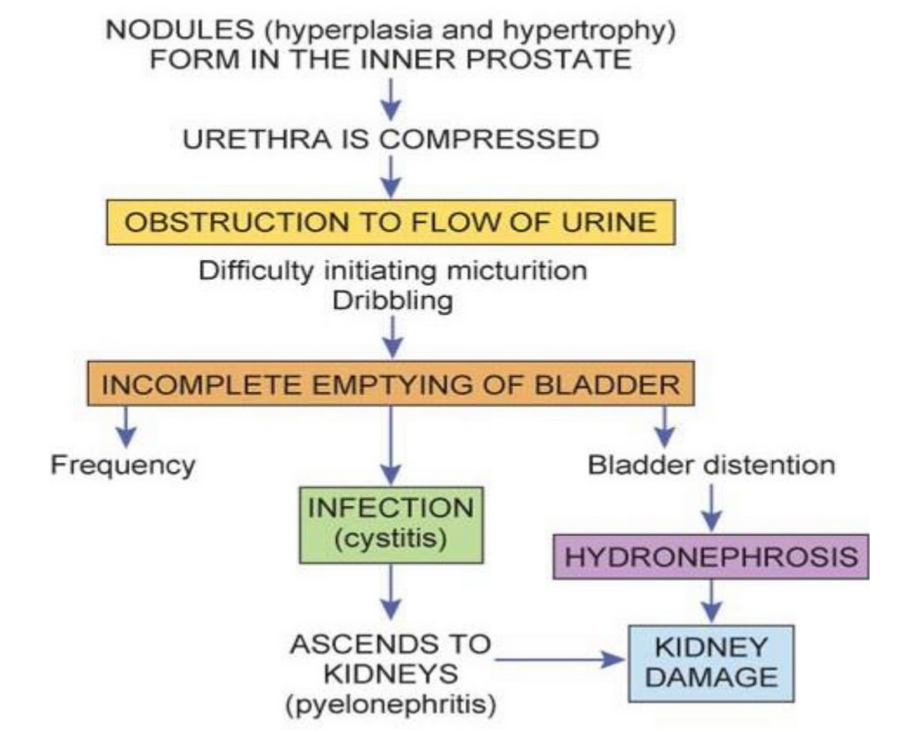 <ul><li><p><span style="background-color: transparent;">Actually hyperplasia not hypertrophy</span></p></li><li><p><span style="background-color: transparent;">Not cancer, common in older men (50% of those over 65 years)</span></p></li><li><p><span style="background-color: transparent;">Can vary from mild to severe</span></p></li><li><p><span style="background-color: transparent;">Hormonal change associated with aging</span></p></li><li><p><span style="background-color: transparent;">Prostate goes from smooth to bumpy, irregular, and enlarged</span></p></li><li><p><span style="background-color: transparent;">Some fibrosis</span></p></li><li><p><span style="background-color: transparent;">Losing testosterone</span></p></li><li><p><span style="background-color: transparent;">With frequent but difficult and possibly painful urination</span></p></li></ul><p></p>