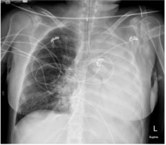 <p>The left lung demonstrates opacification. The radiating air densities noted superimposed over the region of increased density is termed: </p><p>a. air bronchogram sign </p><p>b. target sign </p><p>c. bulging fissure sign </p><p>d. silhouette sign</p>