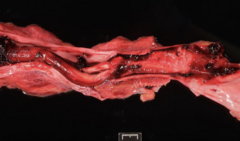 <p>Case: Seabiscuit, 11-yo, MC horse • Presented for colic with secondary hypoproteinemia, suspect DIC. </p><p>Diagnosis? </p><p>Please state two reasons for this to occur.</p>