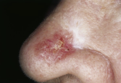 <p>white, waxy, scar-like papule or plaque with indistinct borders, usually appears on the face</p>
