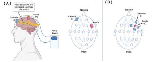 <p><span>Long repetitive sessions of stimulating the brain is thought to use one of two mechanisms<br>1. Enhance activity in the areas immediately surrounding the lesion<br>2. Enhance activity on the contralateral side, creating a compensatory effect<br> The mechanisms rely on neuroplasticity<br> Neuroplasticity: the brain’s ability to change and adapt structure &amp; function</span></p>