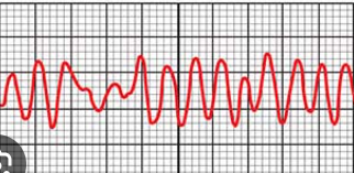 <p>VF (ventricular fibrillation) - ECG</p>