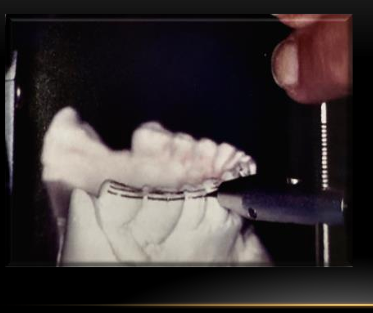 <p>-this will be the height of the buccal cusp tips</p><p>-a preparation line is formed by opening the calipers 1.5mm</p>