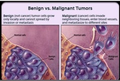 <p>A dangerous cancerous growth that sheds cells into body fluids and spreads to new locations to start new cancer colonies</p>