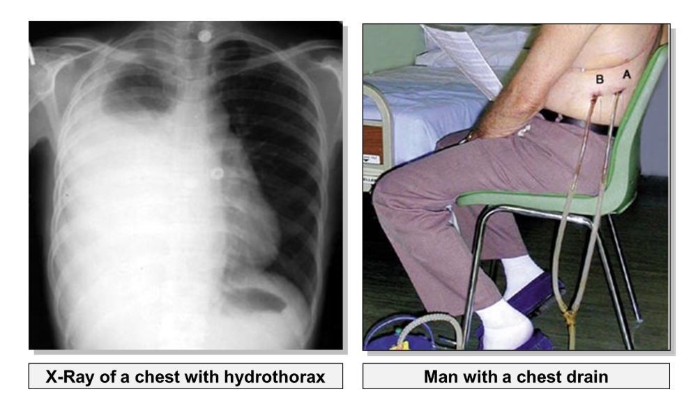 <p><span><span>pressure on an airway/ lungs from outside&nbsp;- a swollen lymph nodes or fluid/ air between the lining of the lungs (visceral pleura) and the chest wall (parietal pleura) i.e, in the pleural cavity.</span></span></p>