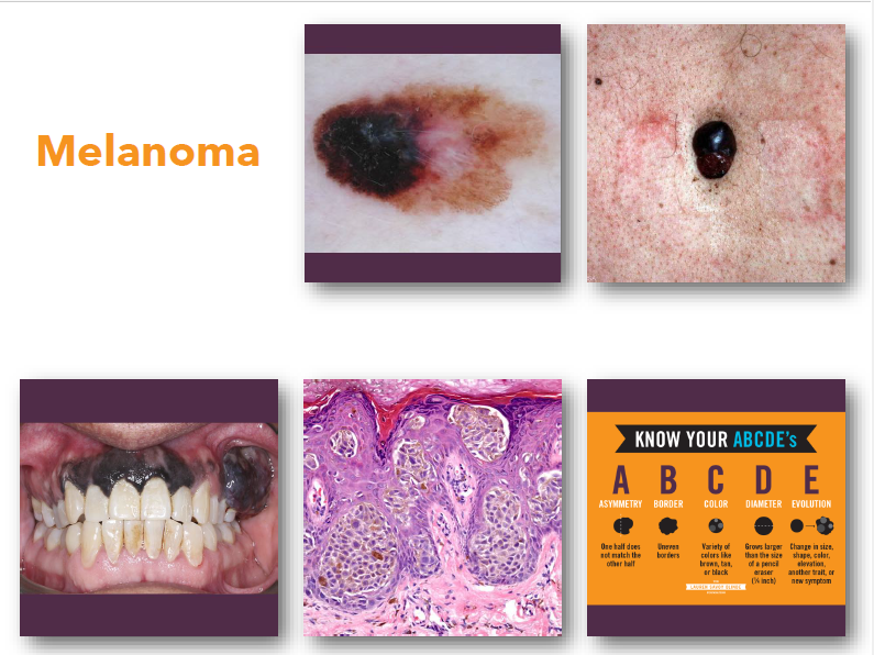 <p>melanoma</p>