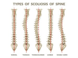 <p>Hyperlordosis</p>