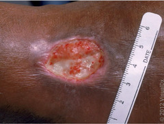 <p>erosion and inflammation of an epithelial surface</p>