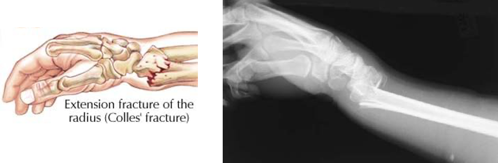 <ul><li><p>Falls outward</p><ul><li><p>Hand goes forward and the bone goes <strong>anteriorly</strong> </p></li></ul></li></ul><p></p><img src="https://assets.knowt.com/user-attachments/72a19745-d633-4f8f-bc48-9c3034073252.png" data-width="100%" data-align="center"><p></p>