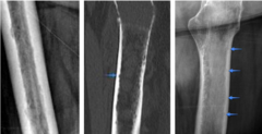 <p>What cortical change is being shown?</p>