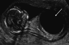 <p>Megacystis is an enlarged bladder. It has a similar etiology to hydronephrosis, but can be diagnosed earlier and is more likely to result in spontaneous abortion. The main cause is bladder outlet obstruction. This process can occur for several reasons including ectopic ureter, megaureter, and uroteric-pelvic junction.</p>