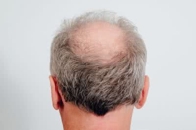 <p>→ <span><strong>with little or no </strong></span>hair<span><strong> on the </strong></span>head</p>