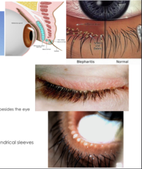 <p>-redness of the eyelids "red rimmed"</p><p>-mild conjunctival hyeremia</p><p>-crusting, scaly debris on lid margin; collarettes and cylindrical sleeves</p><p>-itching, gritty burning sensation, FB sensation, tearing</p>