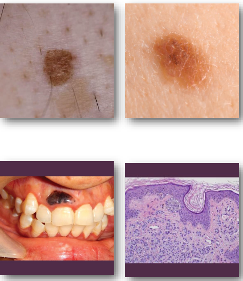 <ul><li><p>characteristics of both dermal and junctional nevi </p></li></ul><p></p>
