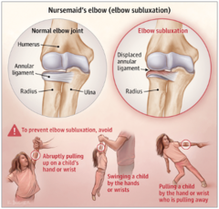 <p>CC: sudden pain and loss of function</p><p>Child will hold arm slightly flexed and pronated</p><p>No focal pain or tenderness to palpation</p>