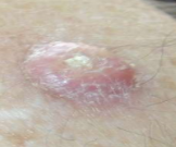 <p>Keratoacanthoma definition*</p>