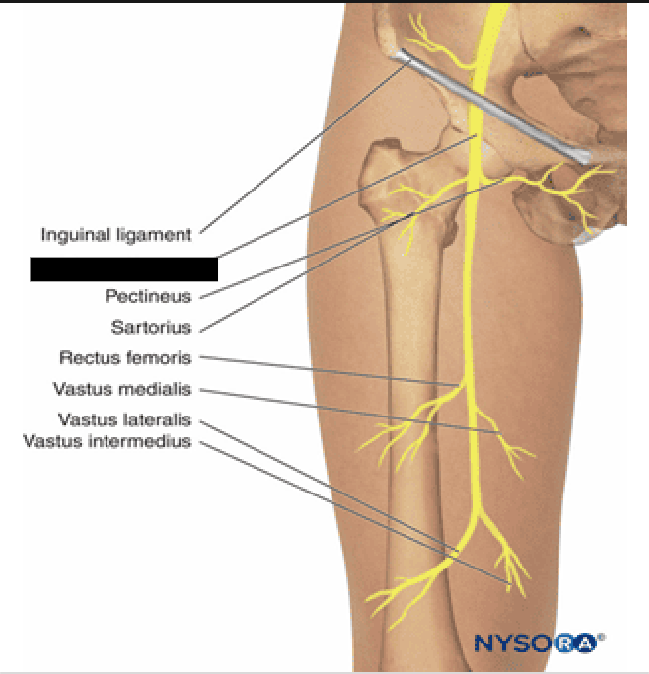 <p>the largest nerve in the<strong> lumbar plexus</strong>, originating in the lower back (L2–L4) and running down into the leg<span>. It is a mixed nerve, meaning it controls both motor functions (muscle movement) and sensory functions (feeling)</span></p>