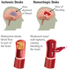 <p>last known to be without signs of a stroke (important for treatment options)</p>
