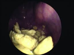 <p>Guttural pouch chondroids are a common complication of what disease?</p>