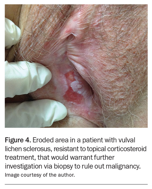 <p>Benign, chronic, progressive dermatologic condition characterized by marked inflammation, epithelial thinning, and distinctive dermal changes accompanied by symptoms of pruritis and pain </p><p>-Presentation: pruritis and soreness that interferes with sleep, anal discomfort, dyspareunia, dysuria, white atrophic papules on the vulva </p><p>-Dx: clinical, biopsy is definitive </p><p>-Tx: topical corticosteroids </p>