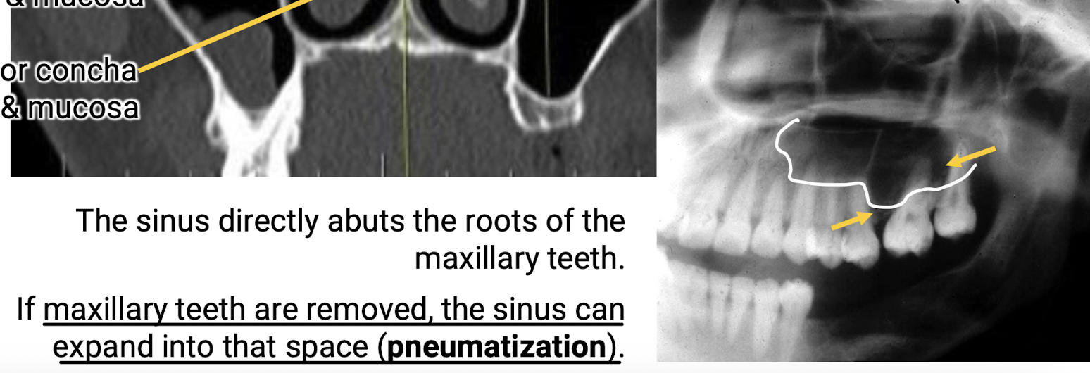 <p>Removal of maxillary teeth can allow the sinus to expand into that space (pneumatization).</p>