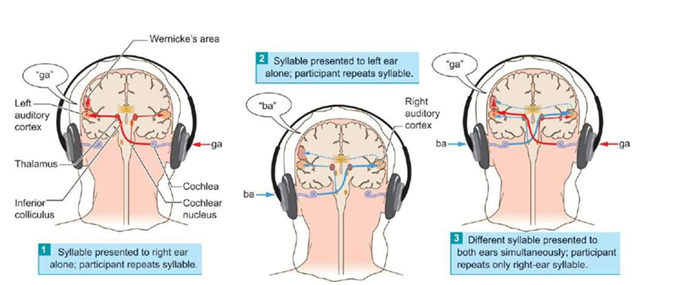 <p>Verschillende info aan beide oren aanbieden waardoor de hemisferen concurrerende info krijgen</p>