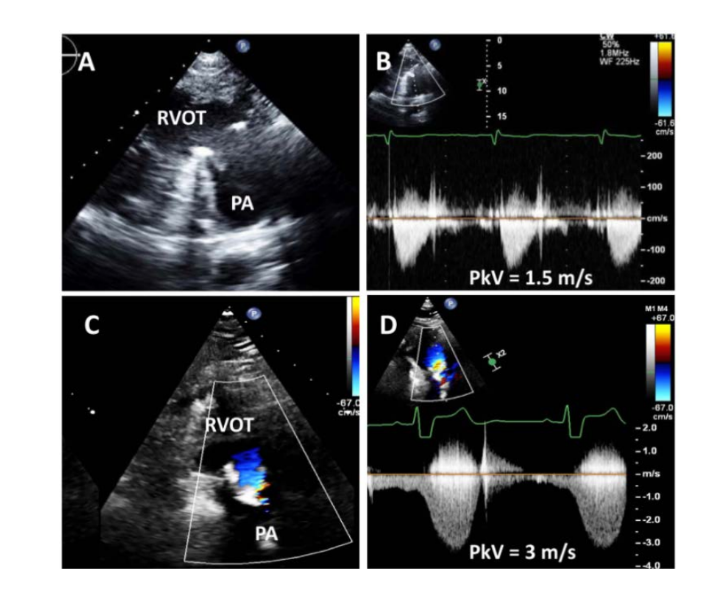 <p>Obstruction may occur further along a conduit or in the PA rather than at the</p><p>valve</p><p>PW Doppler is helpful in determining the precise location of obstruction</p><p>Quantitative parameters are generally limited to peak velocity and mean</p><p>gradient</p>