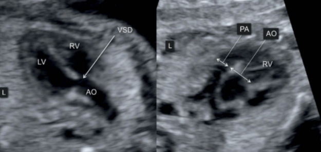 <ul><li><p><span style="background-color: transparent;">Y-shaped overriding aorta with outflow from both ventricles</span></p><ul><li><p><span style="background-color: transparent;">PA stenosis</span></p></li></ul></li><li><p><span style="background-color: transparent;">VSD </span></p></li><li><p><span style="background-color: transparent;">RV outflow anomalies</span></p></li><li><p><span style="background-color: transparent;">RV hypertrophy</span></p><ul><li><p><span style="background-color: transparent;">Muscle has to work harder to pump blood through PV</span></p></li></ul></li></ul><p></p>