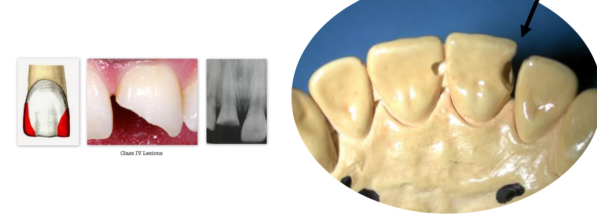 <p>Smooth proximal surfaces of anterior teeth (incisors and</p><p>canines) which involve the incisal edge as well</p>