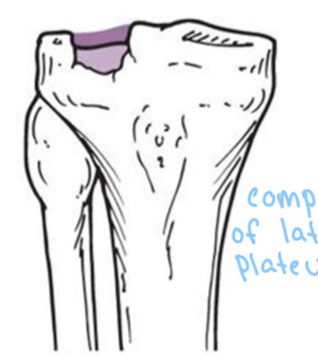 <p>What type of fracture does this show?</p>