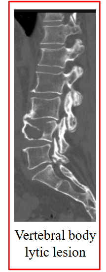 <p>- Bone pain: lower back is common</p><p>- Bone (pathological) fracture without obvious injury: osteolytic bone lesions from increased osteoclastic and decreased osteoblastic activity</p><p>- Infections: infection difficult to overcome(pneumonia is common presenting feature)</p><p>- Kidney problems; renal failure</p><p>- Epistaxis (heavy nosebleeds) or easy bruising</p><p>- Drowsiness; confusion (high serum protein)</p><p>- Symptoms of bone marrow failure: anaemia</p>