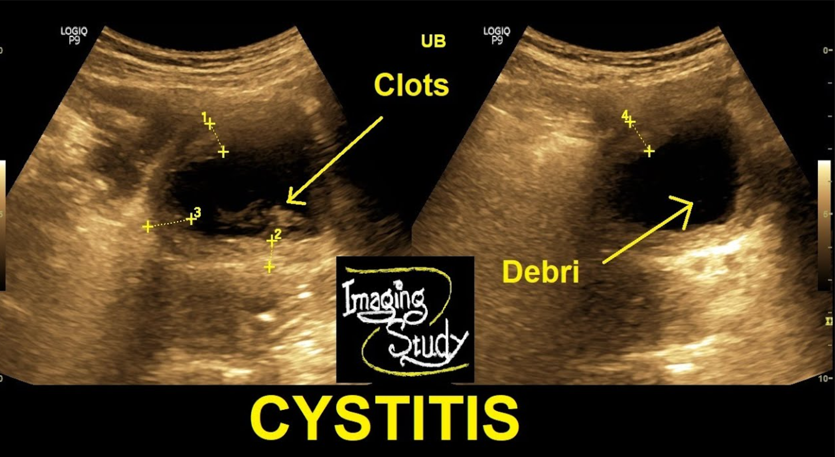 <p>- hypoechoic wall</p><p>- focally or diffusely thickened wall</p><p>- may contain echogenic material</p>