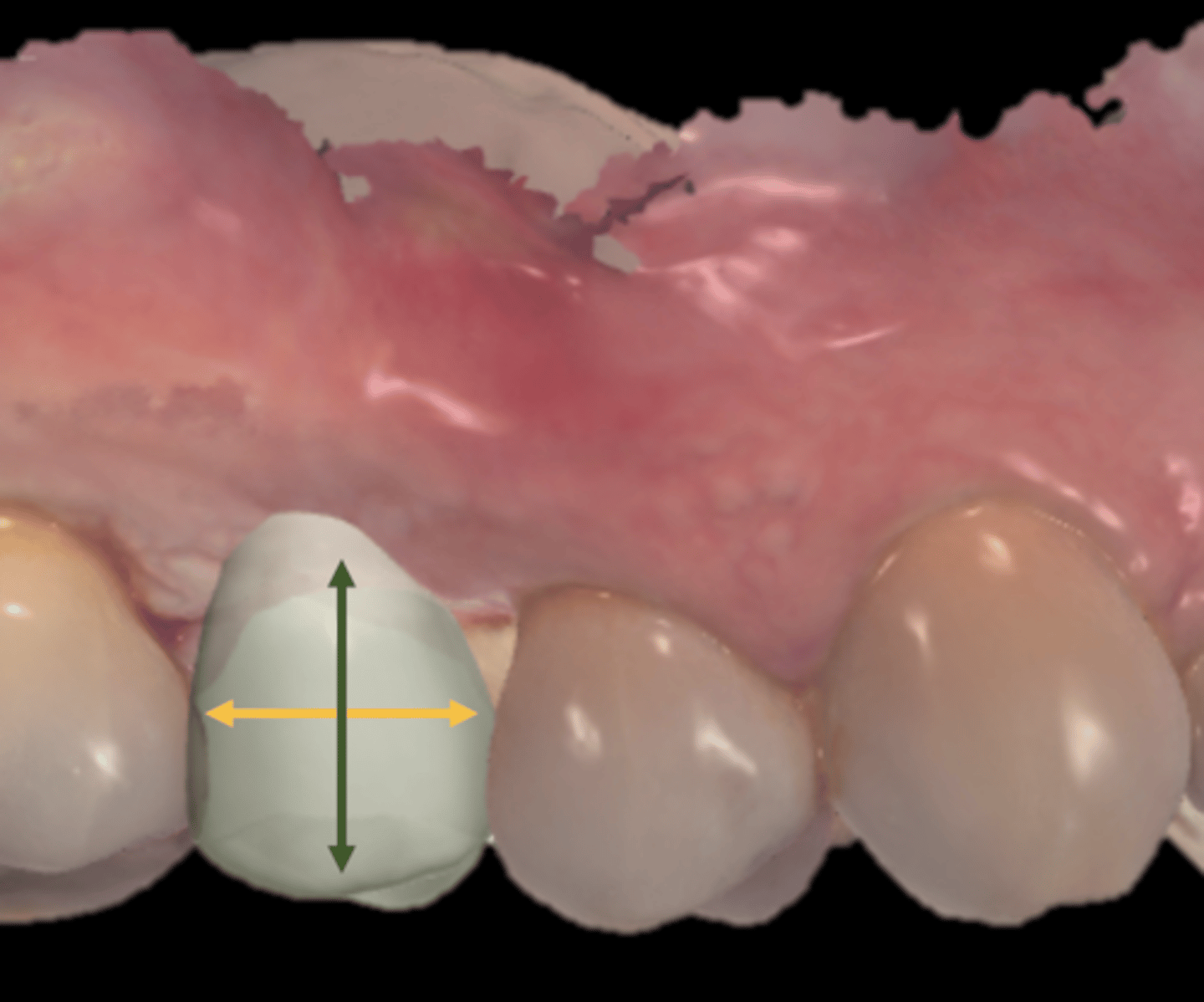 <p>What is the Vertical Minimal Space for clearance (prosthetic space)?</p><p>Green Arrow</p>