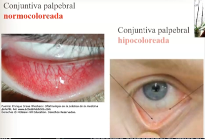 <ul><li><p>Valoración de la coloración, a nivel de:</p><ul><li><p>Mucosa conjuntival <strong>palpebral</strong> (bajando el parpado inferior)</p></li><li><p>Mucosa conjuntival <strong>bulbar</strong> (mirando el globo ocular)</p></li><li><p>Mucosa sublingual</p></li></ul></li></ul><p></p><p>Bien coloreadas/ hipocoloreadas/ Hipercoloreadas/ ictéricas</p>