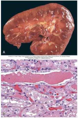<p>Renal cortices red-brown to blue-black(Figure A) with intratubular myoglobin casts and tubular necrosis (Figure B) → Myoglobin nephrosis</p><p>Urine reddish brown (UA – heme+), Muscle enzymes elevated(CK) indicate muscle damage</p>