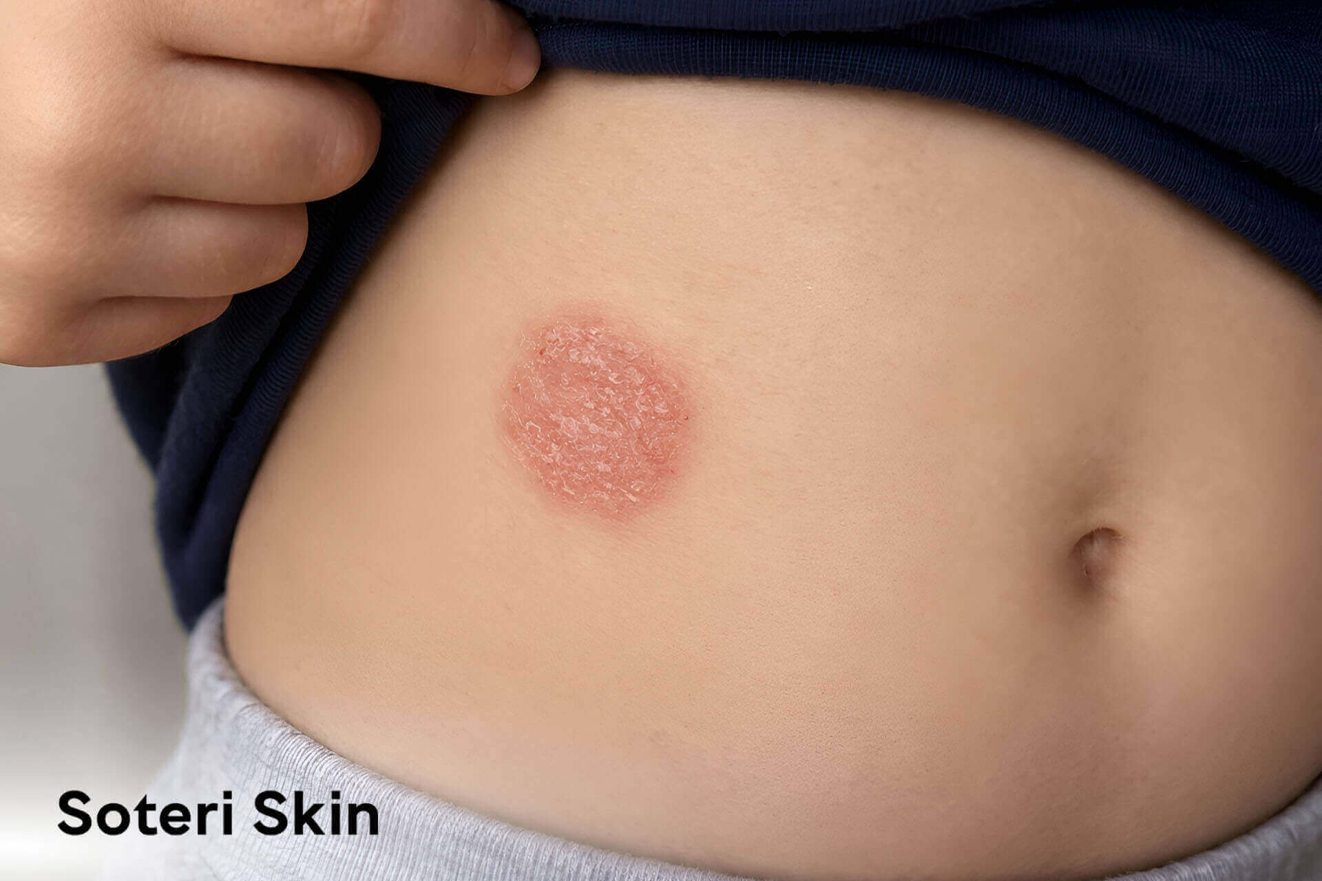 <p>Nummular dermatitis appears as round or coin-shaped patches of eczema on the skin, often characterized by dry, scaly, and sometimes itchy lesions that can ooze or crust. </p>