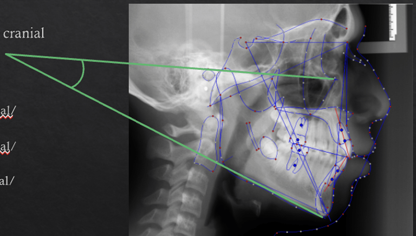 <p>What skeletal measurement:</p><p>- Frankfort Horizontal vs. Mandibular Plane</p><p>- Vertical relationship between the cranial base and the mandible</p><p>- Tells you about the vertical angulation of the mandible</p>