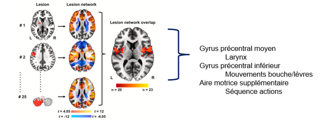 <p><span style="font-family: "Courier New"; line-height: 107%;">o</span><span style="font-family: "Times New Roman"; line-height: normal; font-size: 7pt;">&nbsp;&nbsp; </span><span style="font-family: "Times New Roman", serif; line-height: 107%;"><strong>Gyrus précentral moyen</strong></span></p><p class="MsoListParagraph"><span style="line-height: 107%;">§</span><span style="font-family: "Times New Roman"; line-height: normal; font-size: 7pt;">&nbsp; </span><span style="font-family: "Times New Roman", serif; line-height: 107%;">Larynx</span></p><p class="MsoListParagraph"></p><p class="MsoListParagraph"><span style="font-family: "Courier New"; line-height: 107%;">o</span><span style="font-family: "Times New Roman"; line-height: normal; font-size: 7pt;">&nbsp;&nbsp; </span><span style="font-family: "Times New Roman", serif; line-height: 107%;"><strong>Gyrus précentral inférieur</strong></span></p><p class="MsoListParagraph"><span style="line-height: 107%;">§</span><span style="font-family: "Times New Roman"; line-height: normal; font-size: 7pt;">&nbsp; </span><span style="font-family: "Times New Roman", serif; line-height: 107%;">Mouvements bouche/lèvres</span></p><p class="MsoListParagraph"></p><p class="MsoListParagraph"><span style="font-family: "Courier New"; line-height: 107%;">o</span><span style="font-family: "Times New Roman"; line-height: normal; font-size: 7pt;">&nbsp;&nbsp; </span><span style="font-family: "Times New Roman", serif; line-height: 107%;"><strong>Aire motrice supplémentaire</strong></span></p><p class="MsoListParagraph"><span style="line-height: 107%;">§</span><span style="font-family: "Times New Roman"; line-height: normal; font-size: 7pt;">&nbsp; </span><span style="font-family: "Times New Roman", serif; line-height: 107%;">Séquence actions</span></p>