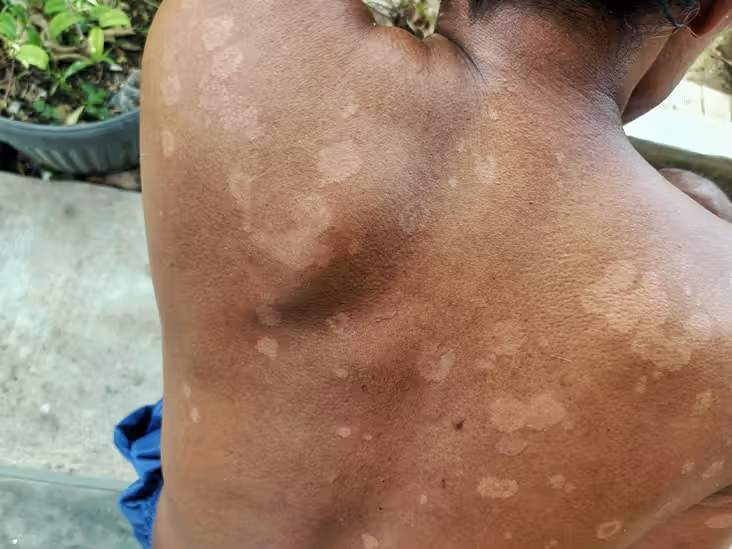 <p>Which fungal infection may present with areas of pink or white macules, commonly on the upper torso, that may be confused with vitiligo in patients of dark complexions?</p>