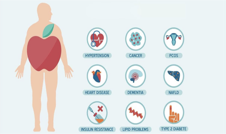 <p>HTN (most common)</p><p>CAD</p><p>HLD<br>DM<br>Coagulopathy</p><p>Cholelithais</p><p>DJD<br>OSA</p>