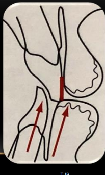 <p>-must be determined in the mouth</p><p>-gingival contour guides, then tucks in to touch the lower lip wet/dry line</p>