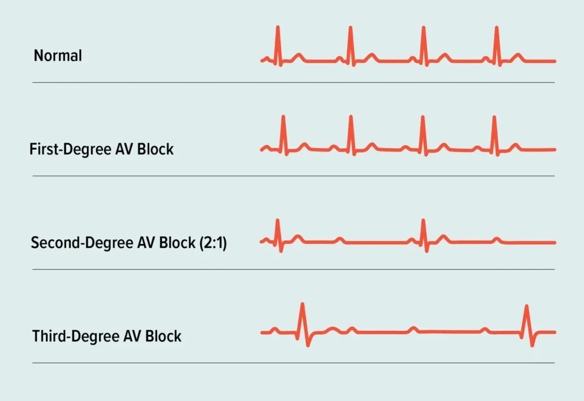 <p>Heart block (ECG)</p>