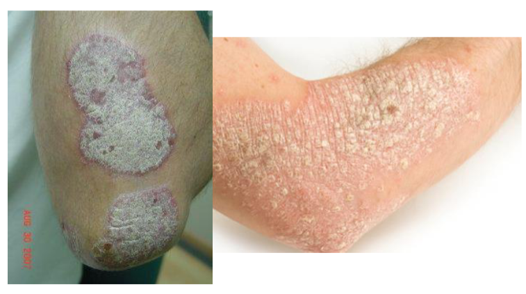 <p>PLAQUE</p><p>raised, >_____ in diameter</p>