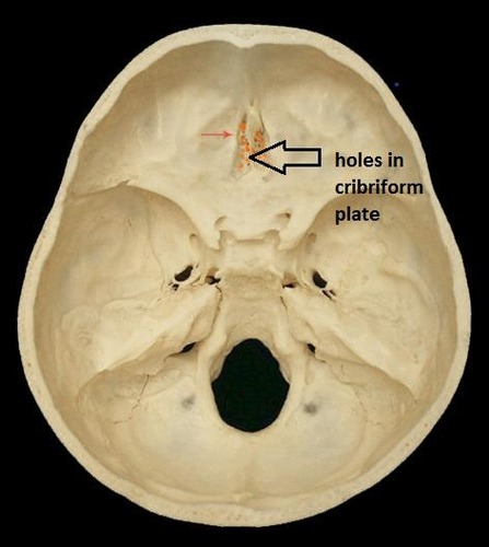 <p>holes in cribiform plate</p>