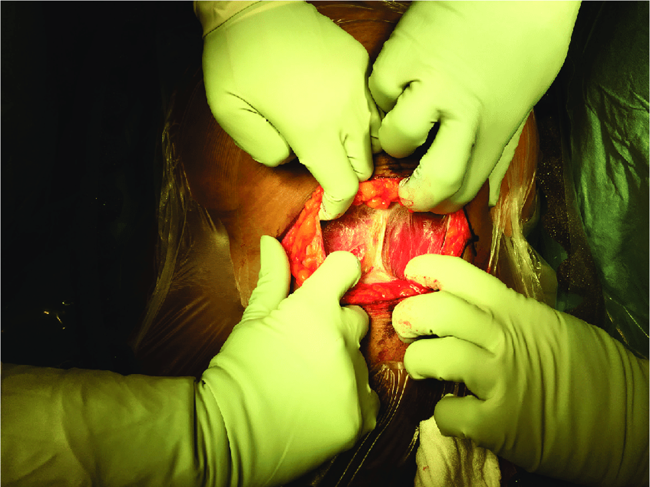 <ul><li><p><span><span>Incise anterior rectus sheath transversely</span></span></p></li><li><p><span><span>Extend laterally</span></span></p></li><li><p><span><span>Separate fascia from rectus muscles</span></span></p></li></ul><p></p><p></p>