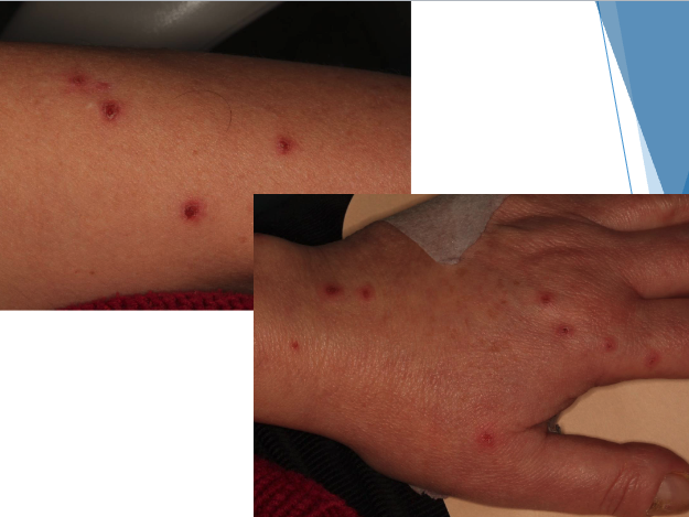 <p>• Erythematous mucosal patches</p><p>• Shallow ulcers</p><p>• Entire perimeter of tongue may be affected</p><p>• Hemorrhagic crusts of lips</p><p>• Targetoid cutaneous lesions</p>