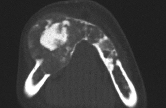 <p>well-defined; commonly mixed RL/ RO; root divergence or resorption of roots can occur </p>