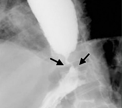 <p>Difficulty swallowing due to a congential or acquired condition, a trapped bolus of food, paralysis of the pharyngeal or esophageal muscles, or inflammation.</p>